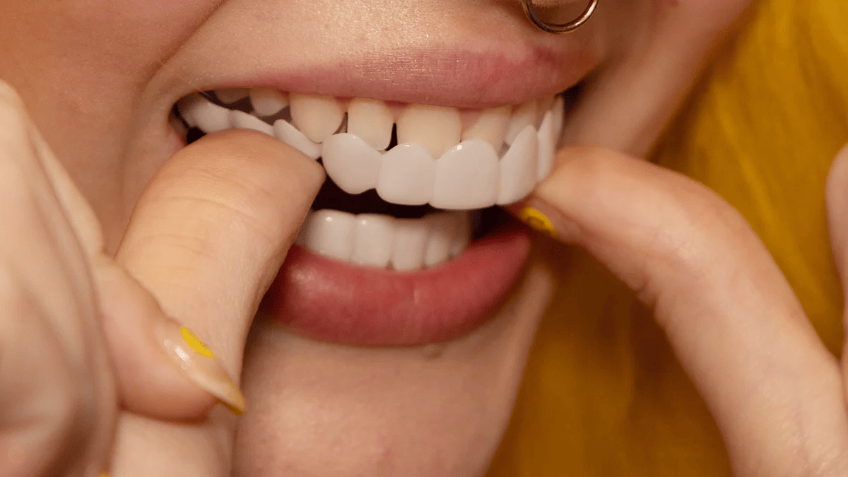 Removable Resin Full-Arch Snap-On Veneers