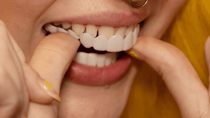 Removable Resin Full-Arch Snap-On Veneers