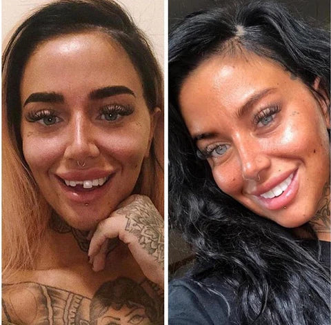 Removable Resin Full-Arch Snap-On Veneers