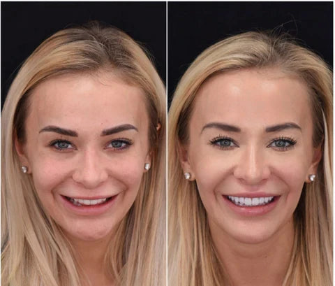 Removable Resin Full-Arch Snap-On Veneers