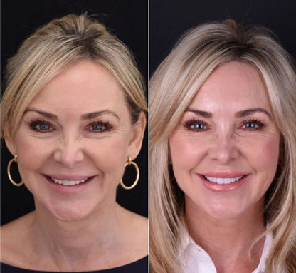 Removable Resin Full-Arch Snap-On Veneers