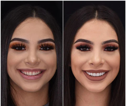 Removable Resin Full-Arch Snap-On Veneers