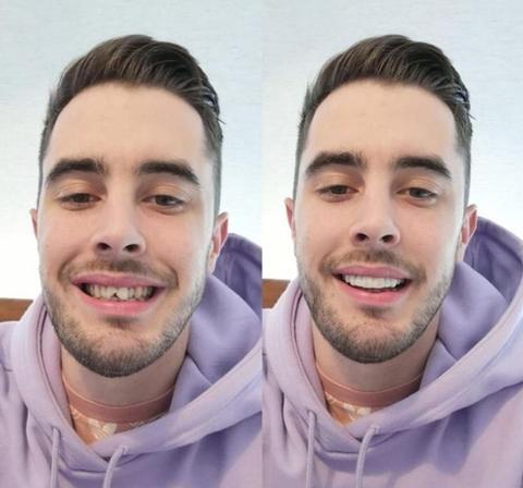 Removable Resin Full-Arch Snap-On Veneers