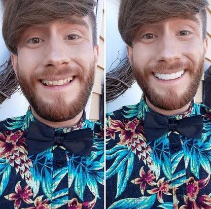 Removable Resin Full-Arch Snap-On Veneers